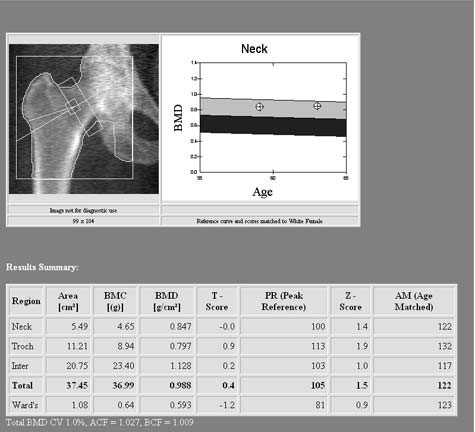 bone density scan